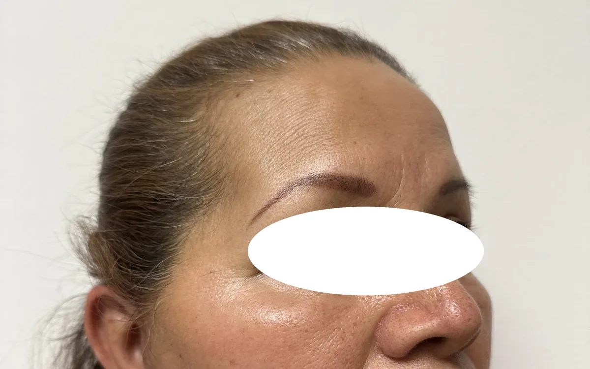 Resultado de blefaroplastia