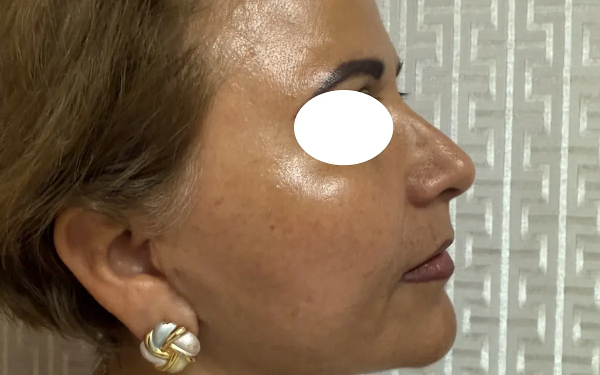 Resultado de lifting cervical y perfilamiento mandibular
