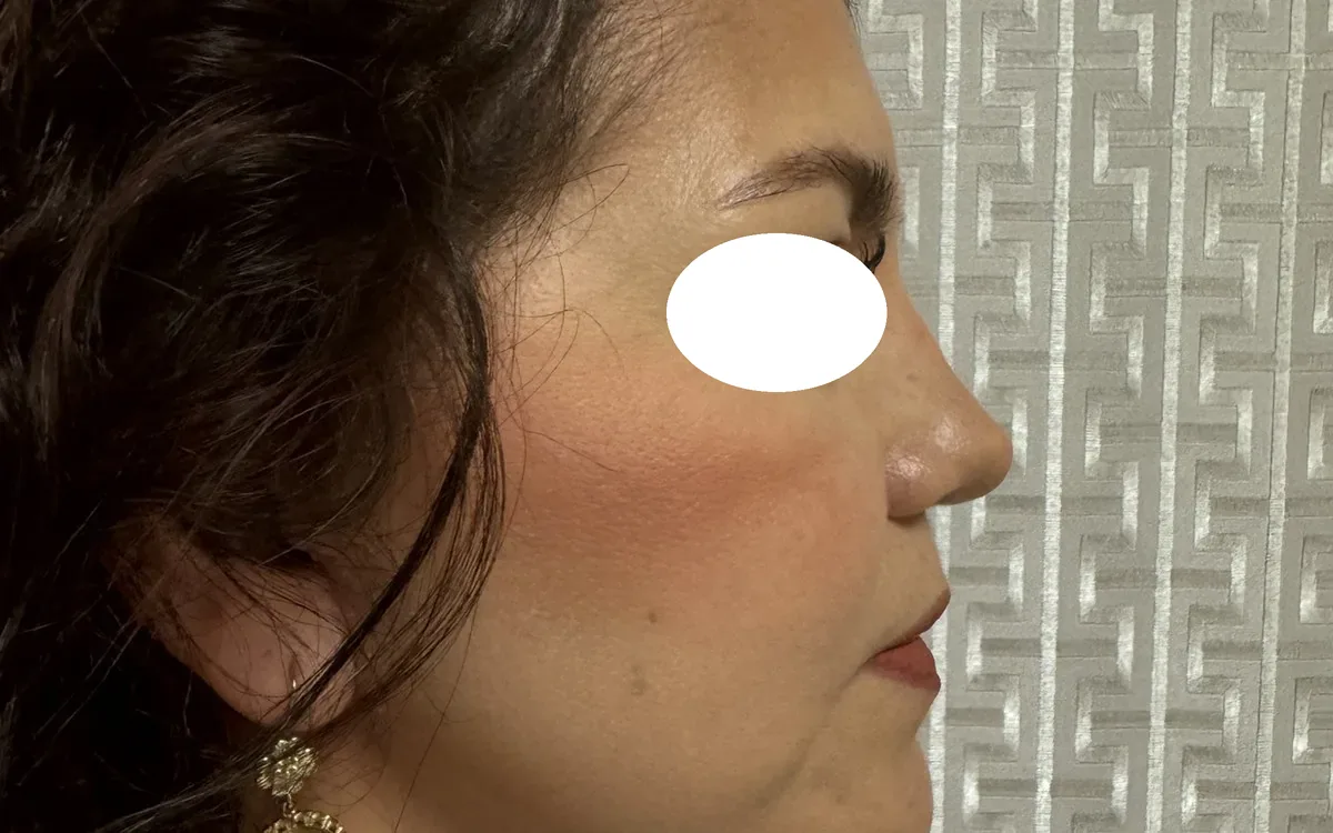 Resultado de lifting facial deep plane